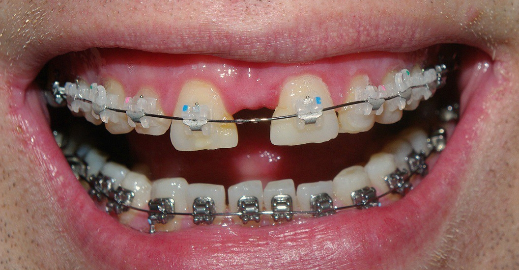 Диастема (щербинка между передними зубами) – что это, причины, как убрать