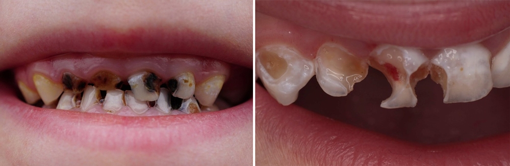 Почему крошатся зубы у детей и взрослых