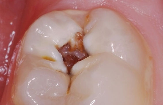Лечение кариеса - цена в 32Dent :: Лечение глубокого и поверхностного кариеса зубов