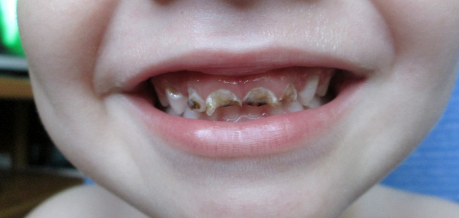 Почему крошатся зубы у детей