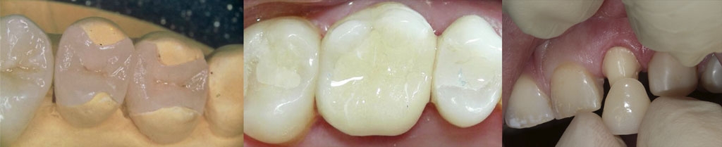 Лечение пульпита 1 канального зуба thumbnail