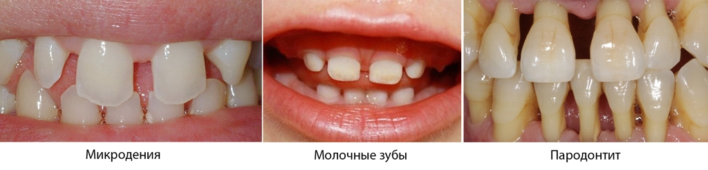 Кратко о кариесе между зубами: развитие и осложнение
