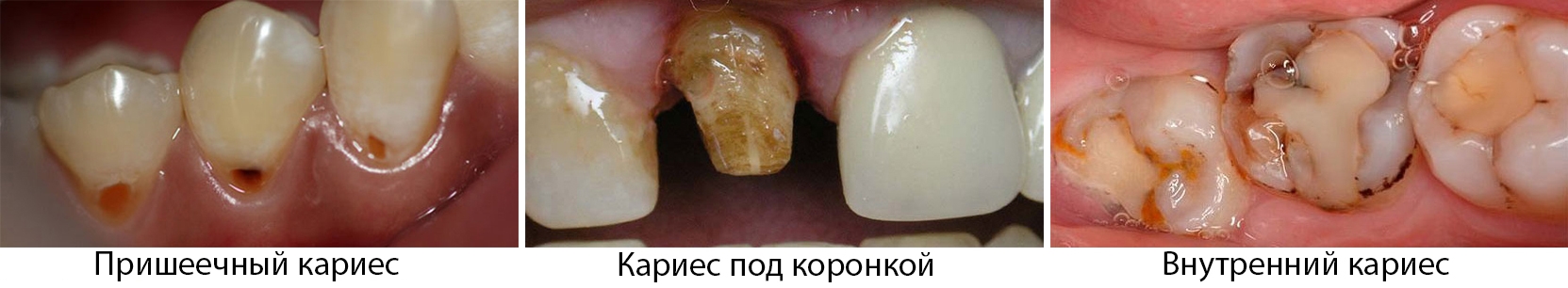 Кариес на передних зубах - что это, лечение, диагностика, симптомы
