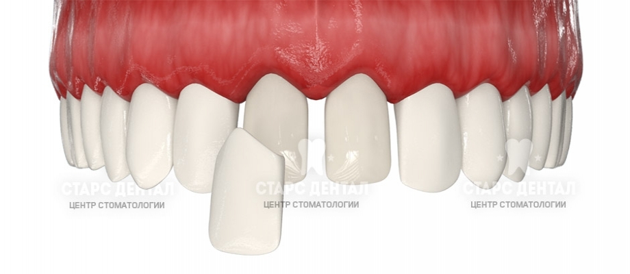 Симптоматика крошения зубов