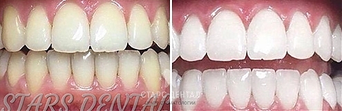 Реставрация 31, 41 зубов