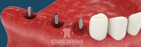 Одномоментная имплантация сразу после удаления зуба. Информация о методе и стоимость в Москве.