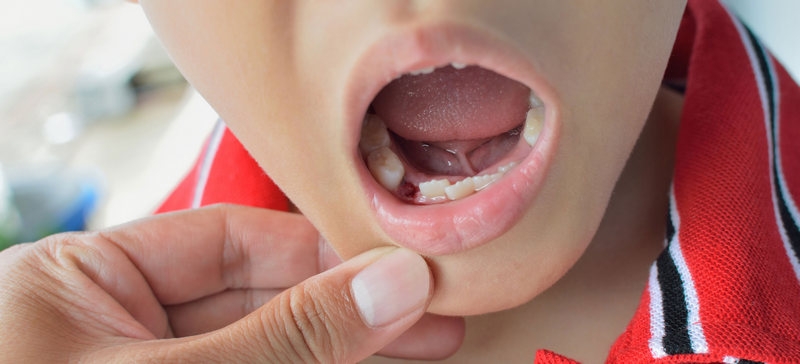Хирургическое лечение зубов у детей thumbnail