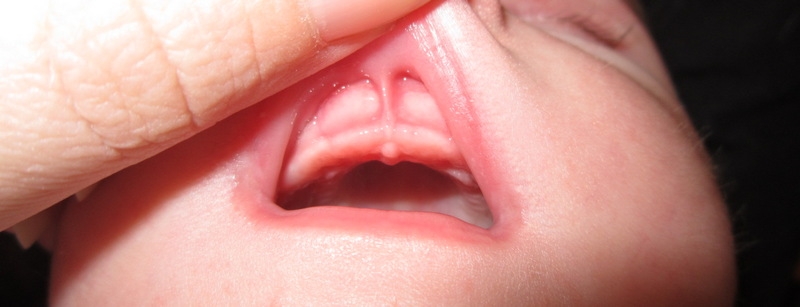 Пластика уздечки губы ребенку